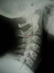 X-Ray Of a Patient's Neck Before Treatment