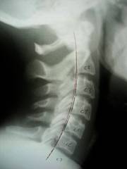 X-Ray Of a Patient's Neck After Three Months Of Treatment