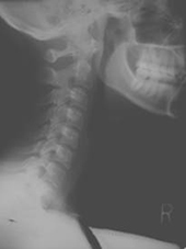 X-Ray Of a Patient's Neck Before Receiving Treatment