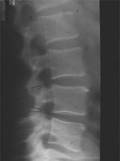 X-Ray Of a Patient's Spine Before Treatment