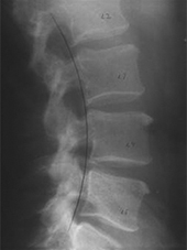 X-Ray of a Patient's Spine After Two Months of Treatment