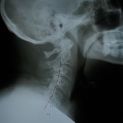 X-Ray Of a Patient's Neck After Three Months Of Treatment