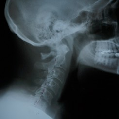 X-Ray Of a Patient's Neck After One Month of Treatment