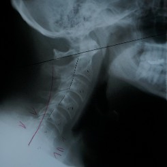 X-Ray Of a Patient's Neck Before Treatment
